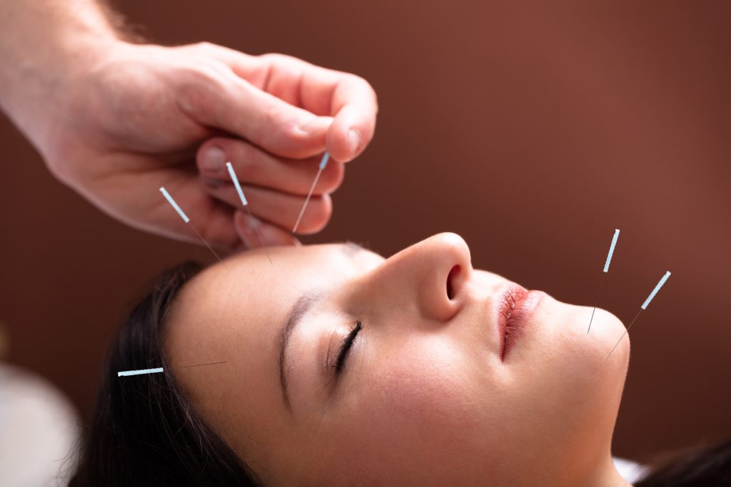 Acupuncture in Ireland: How It Can Enhance Your Well-Being