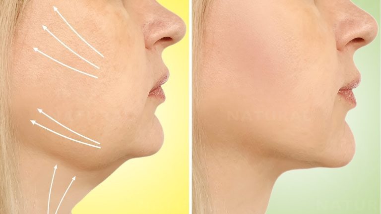 Kybella Before and After: Real Patient Results and Transformations