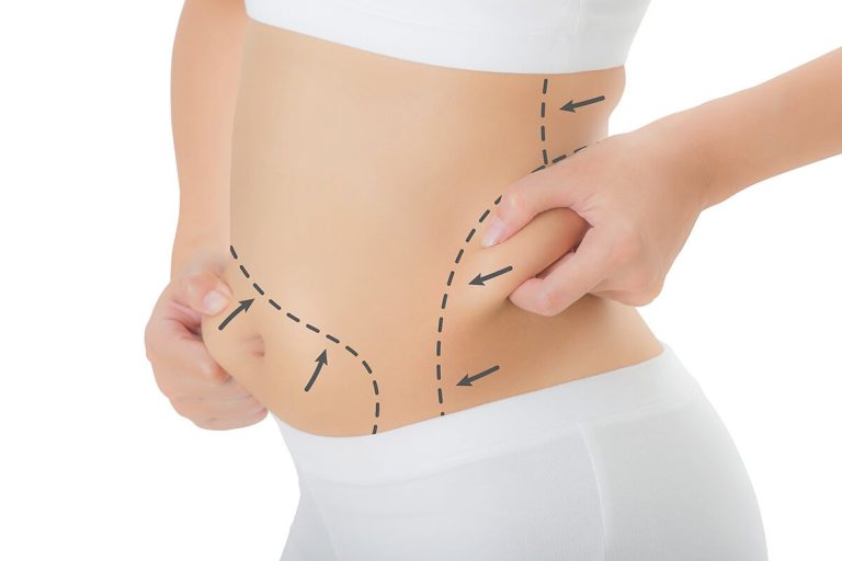 Transforming Your Body: The Ultimate Guide to Liposuction in Dubai