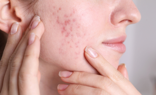 Understanding Acne Scars: Treatment Options and Prevention