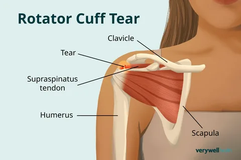 Why Sports Medicine Doctor Interventions Matter in Rotator Cuff and Biceps Tendon Tears